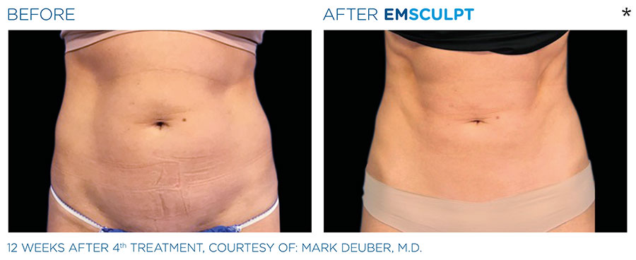 Before and After Photo of abdomen scultping Treatment in Merrimack